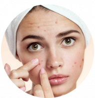 acne-spot-pimple-2